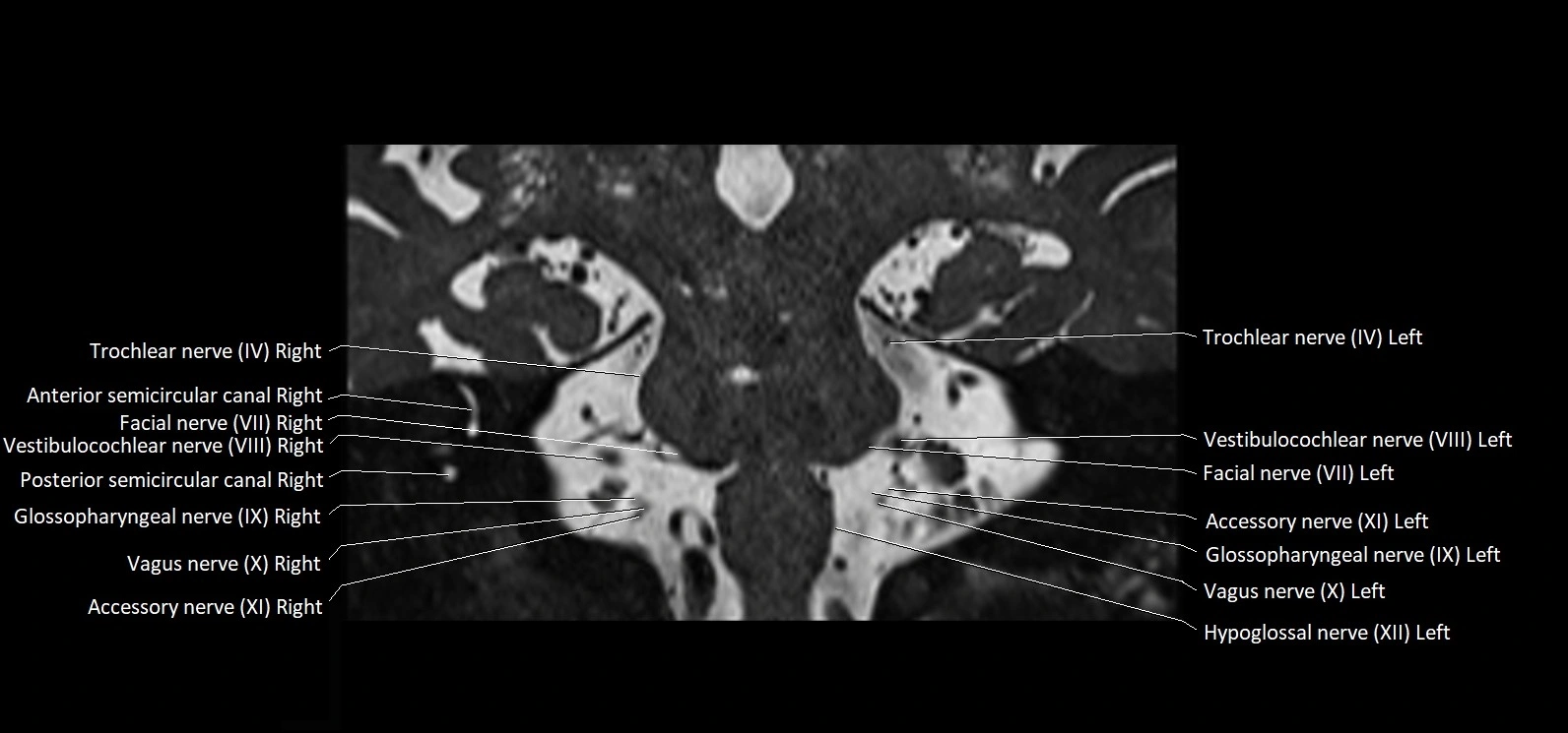 Cranial nerve cross sectional anatomy coronal 3T MRI image 45.webp